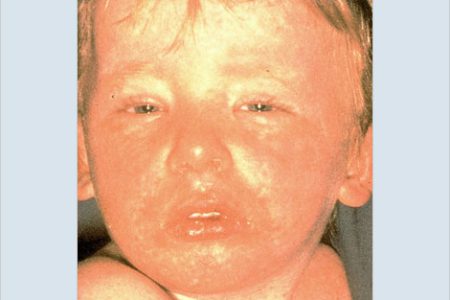 Beware:  the Misery of Measles